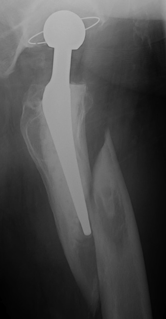 THR Periprosthetic Fracture B1 Lateral